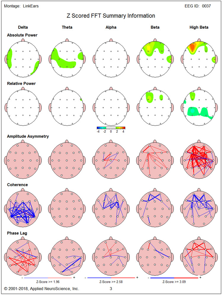 Figure 1 - Baseline eyes-closed NeuroGuide z-score FFT summary report showing elevated high beta